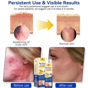 ⭐ CVREOZ® Bee Poison Psoriasis Treatment Spray 🐝 LIMITED OFFER 60% OFF 💛