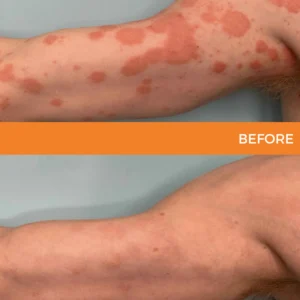 🐝 LIMITED OFFER 60% OFF 💛 Cvreoz® Bee Venom Psoriasis Relief Spray