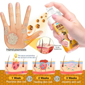 🐝 LIMITED OFFER 60% OFF 💛 Cvreoz® Bee Venom Psoriasis Relief Spray