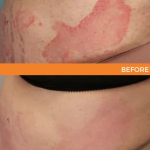 🐝 LIMITED OFFER 60% OFF 💛 Cvreoz® Bee Venom Psoriasis Relief Spray
