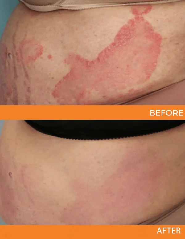 🐝 LIMITED OFFER 60% OFF 💛 Cvreoz® Bee Venom Psoriasis Relief Spray