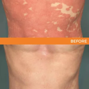 🐝 LIMITED OFFER 60% OFF 💛 Cvreoz® Bee Venom Psoriasis Relief Spray
