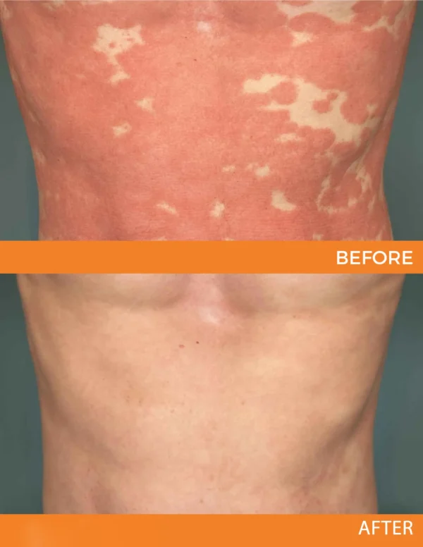 🐝 LIMITED OFFER 60% OFF 💛 Cvreoz® Bee Venom Psoriasis Relief Spray