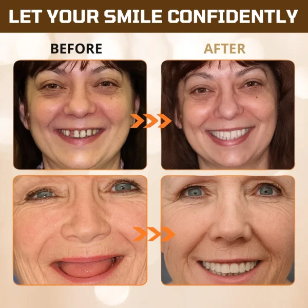 ✅ Official Store: Cvreoz® Adsorptive denture(⏰Limited time discount last 30 minutes⏰)