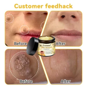 🌟 Official Store | Cvreoz® Bee Venom Skin Treatment Cream🚀LAST DAY 80% OFF(Sagging Skin, Fine Lines, Loss of Firmness, Flat Bust, Drooping Hips, and More) (Copy)