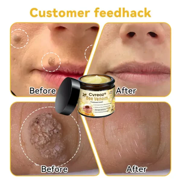 🌟 Official Store | Cvreoz® Bee Venom Skin Treatment Cream🚀LAST DAY 80% OFF(Sagging Skin, Fine Lines, Loss of Firmness, Flat Bust, Drooping Hips, and More) (Copy)