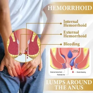 Cvreoz® Apis Venom Hemorrhoid Cooling Spray