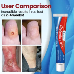 Cvreoz® Diabetic Foot Ulcer Repair Cream✨𝐑𝐞𝐯𝐢𝐭𝐚𝐥𝐢𝐳𝐞 𝐘𝐨𝐮𝐫 𝐅𝐞𝐞𝐭 𝐢𝐧 𝐖𝐞𝐞𝐤𝐬!