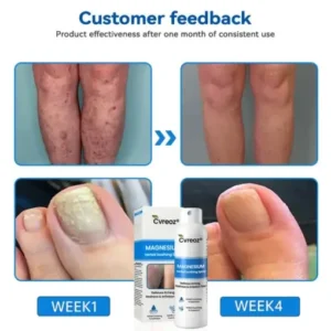 Cvreoz® Magnesium Herbal Psoriasis Spray