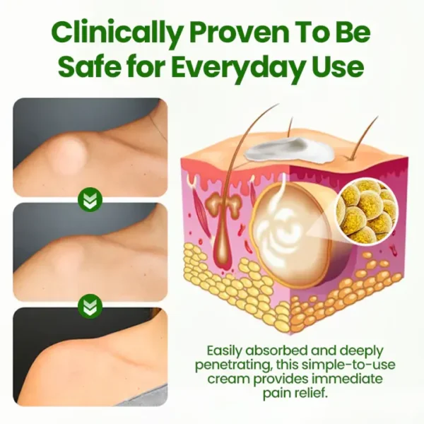 ⏰Last Day Promotion: 60% OFF🔥 Cvreoz® KnotAway Lipoma Removal Cream