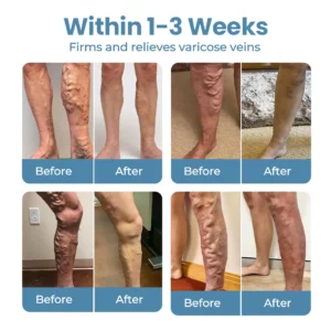 🔥Last Deal: 60% Off🔥 CVREOZ® Herbal Relief Varicose Vein Spray