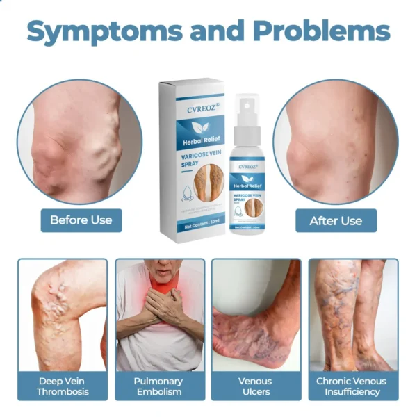 🔥Last Deal: 60% Off🔥 CVREOZ® Herbal Relief Varicose Vein Spray