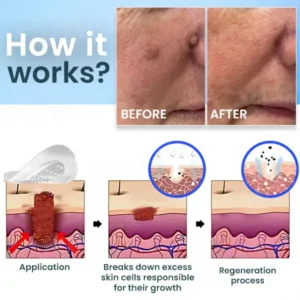 ⚡LIMITED DISCOUNT 40% OFF ON ALL ITEMS ⚡- Cvreoz® Nano-Micro Needle Skin Tags Removal Patches  | No More Hiding that Skin!💕