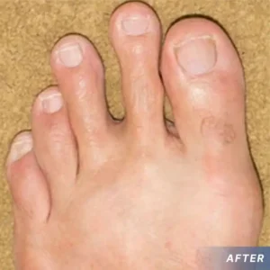 CVREOZ GoutEase Relief Spray