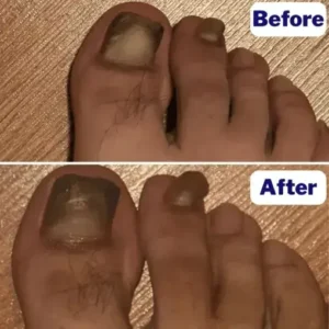 Cvreoz® – Fungal Nail Patches
